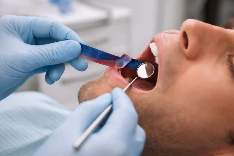 Dentiste vérifiant l’occlusion avec papier articulé après pose d’une couronne dentaire