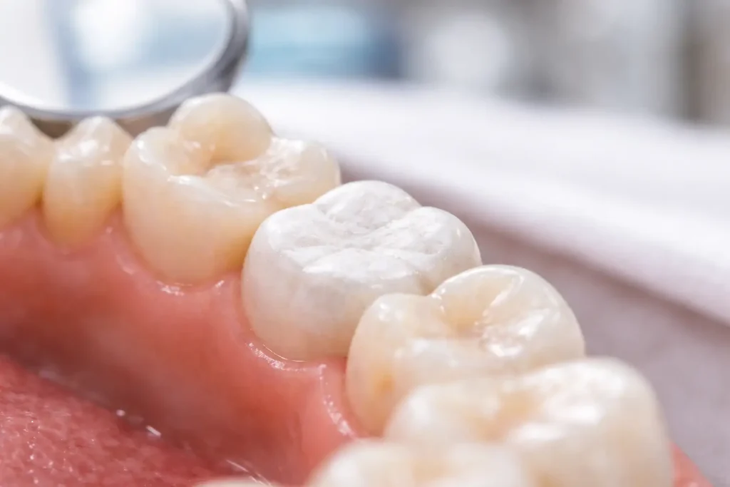 Pansement dentaire provisoire visible sur une molaire